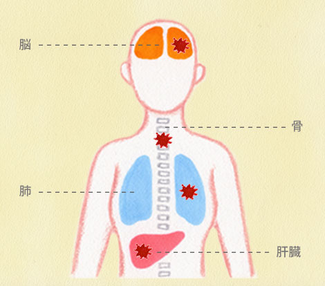 転移の図